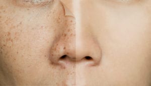 Hyperpigmentation